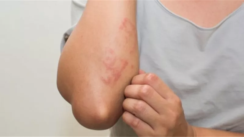 طرق بسيطة للتخفيف من أعراض الحساسية بسرعة