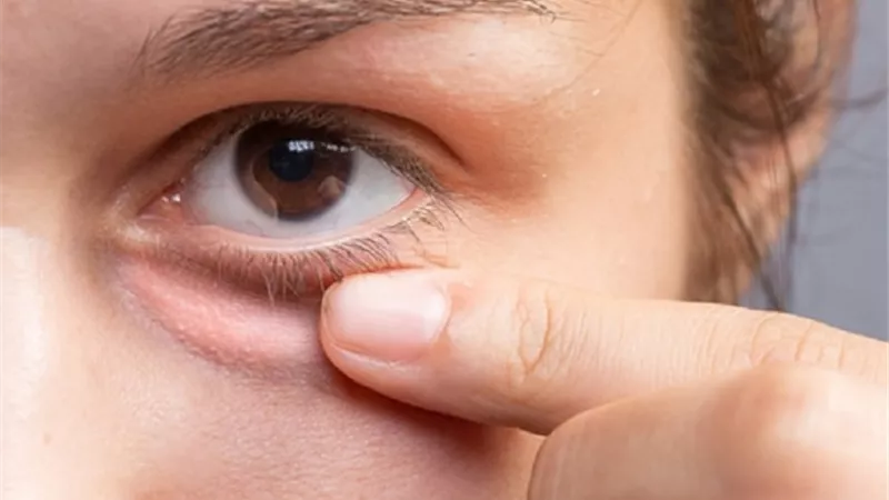 وداعًا لانتفاخ العينين..اكتشف الأسباب وأبسط العلاجات المنزلية