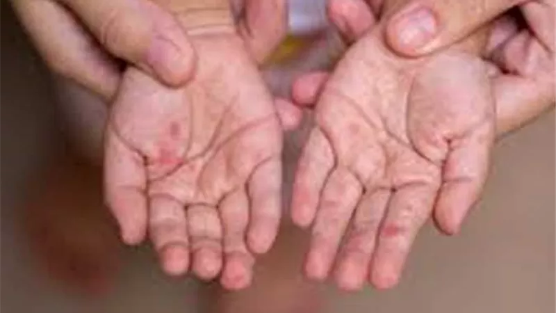 فيروس HFMD يهدد أطفال المدارس.. كيف تقي أسرتك منه؟