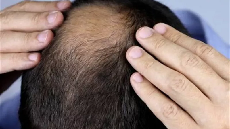 مُحلٍ طبيعي من نبات الستيفيا يعزز فعالية علاج الصلع الوراثي