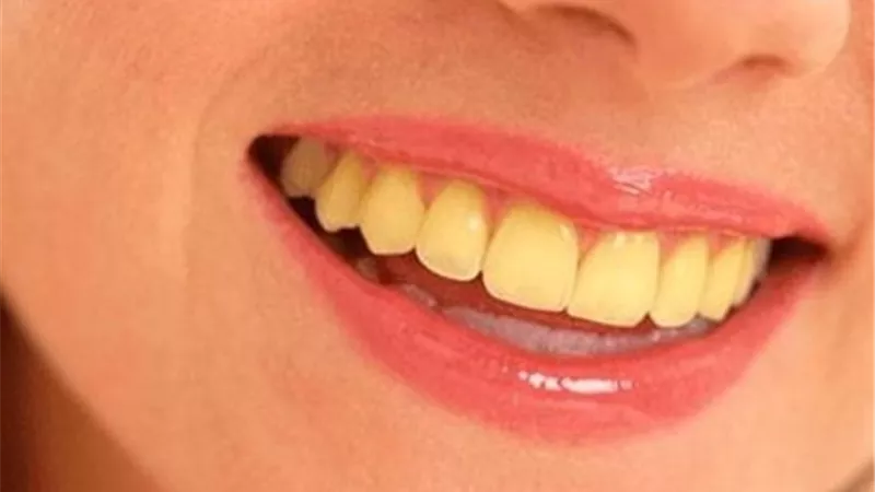 10 أسباب لاصفرار الأسنان