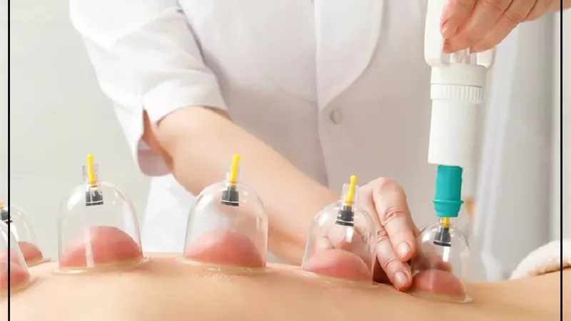 العلاج بالحجامة بين الطب النبوي والعلم الحديث