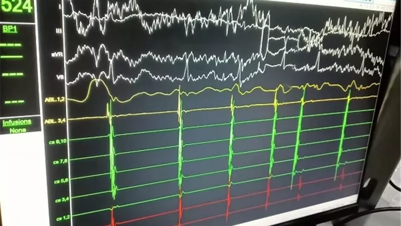 للمرة الأولى بمستشفيات الصحة تشغيل جهاز كهربية