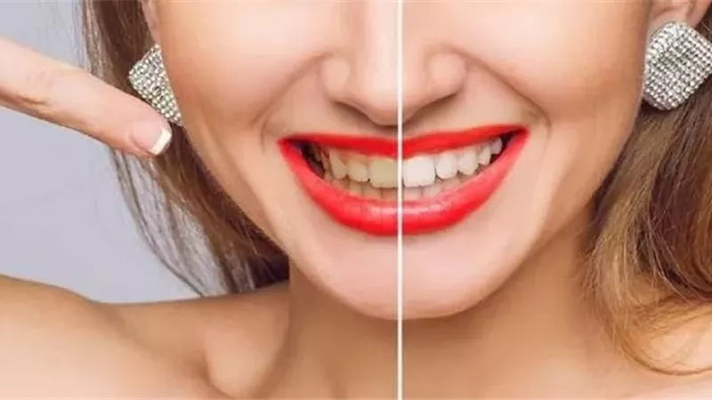 5 أطعمة ومشروبات يومية تسبب اصفرار الأسنان حتى بعد التجميل