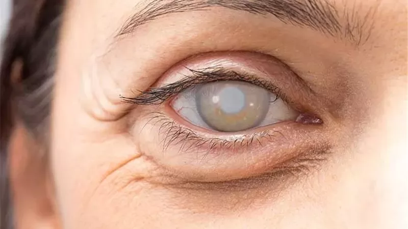 السبب الأساسي لإعتام عدسة العين