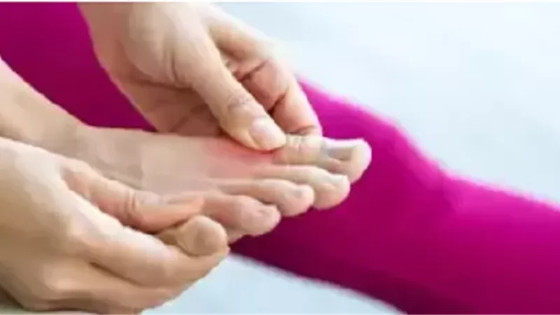النقرس ليس بسبب العادات فقط.. الجينات تلعب الدور الأبرز