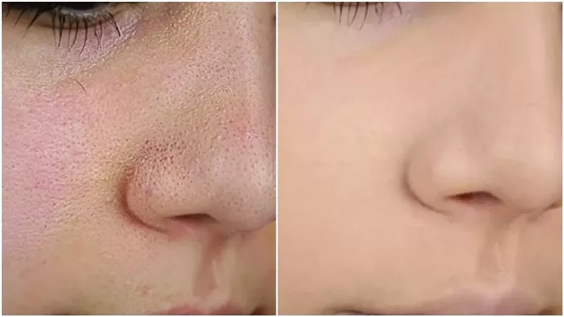 تونرات طبيعية لحل مشكلة المسام الواسعة