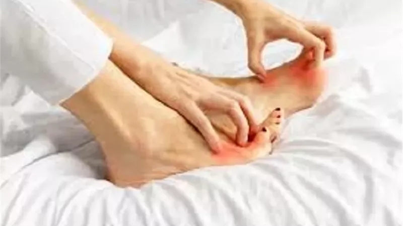 حكة القدمين قد لا تكون عرضًا عابرًا.. تحذير طبي من أمراض خطيرة