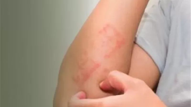 نيموليزوماب.. علاج بيولوجي واعد لتخفيف الحكة السريعة لدى مرضى الإكزيما
