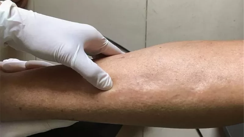 احتباس الماء في الجسم .. الأسباب والأعراض وطرق العلاج الفعّالة
