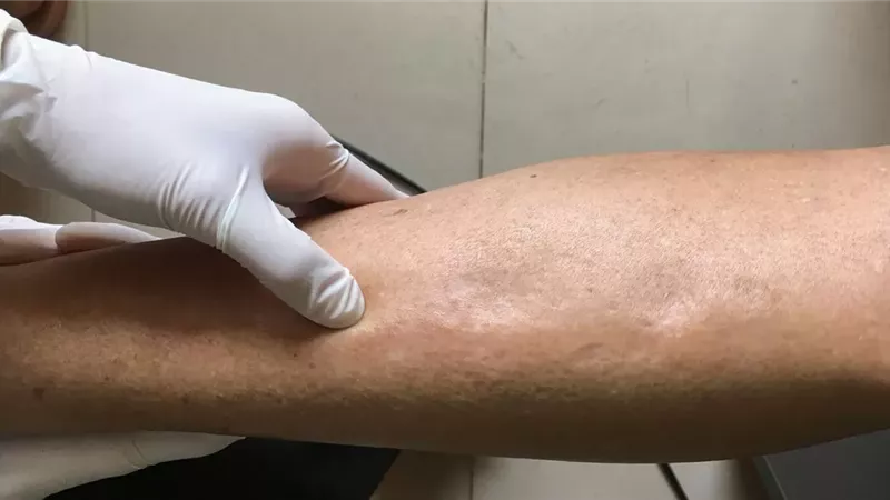 أسباب احتباس الماء في الجسم
