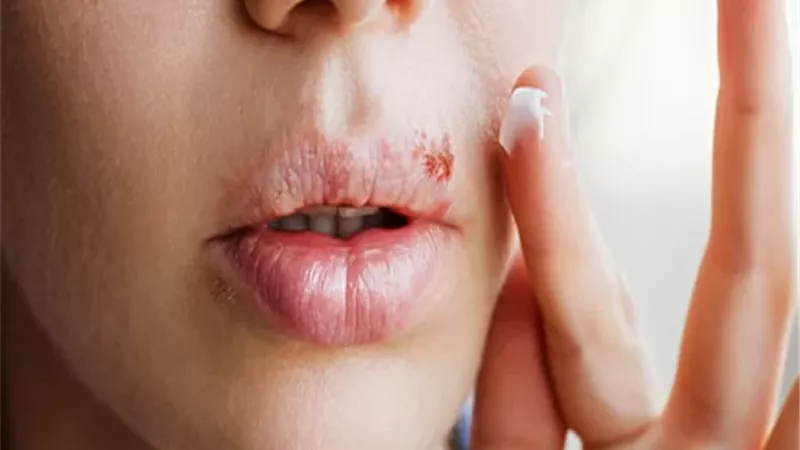 قرحات البرد الجلدية .. الأسباب والأعراض وطرق العلاج الحديثة