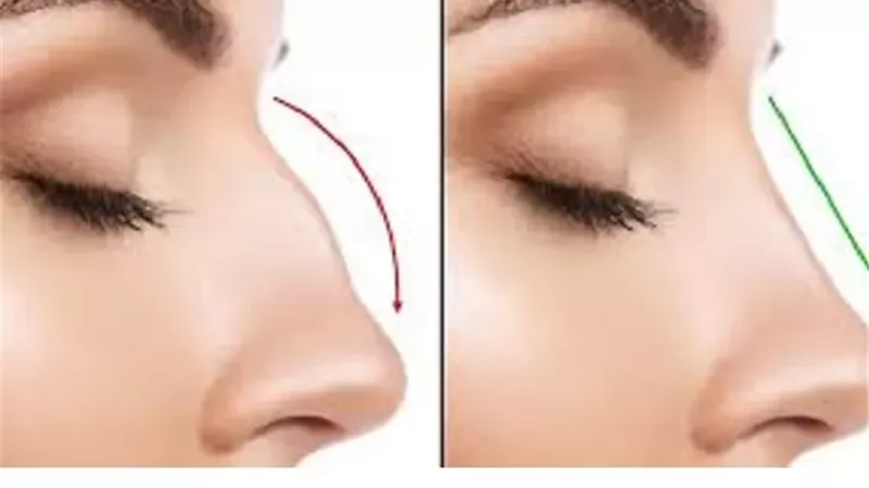 حكم القيام بعملية تجميل في الأنف؟