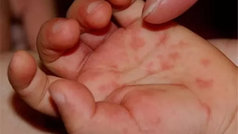 فيروس كوكساكي .. طبيبة توضح الأسباب والعلاج الآمن للأطفال