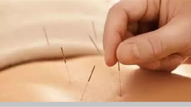 حكم الوخز بالإبر الصينية والقسطرة
