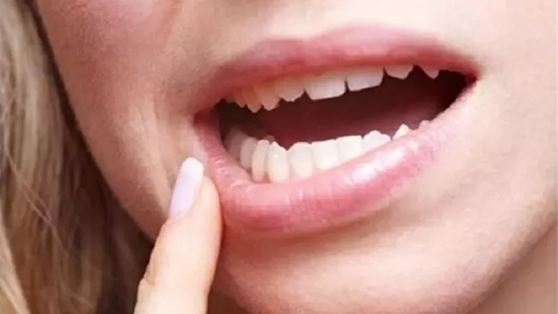 بقع بيضاء أو حمراء في الفم قد تنذر بسرطان الفم