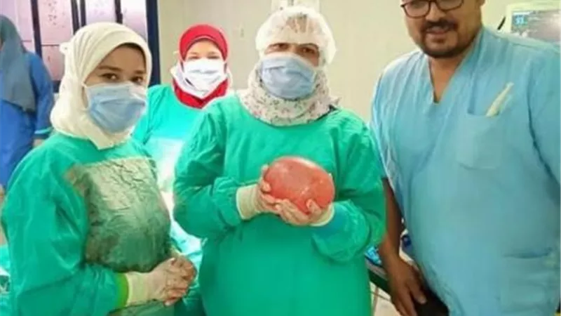 استئصال ورم بوزن 2 كيلو من رحم فتاة بالمستشفى الدولى بالأقصر