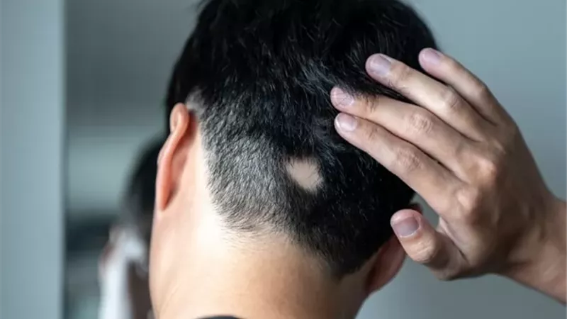 أسباب ظهور الثعلبة في الرأس وفقدان الشعر