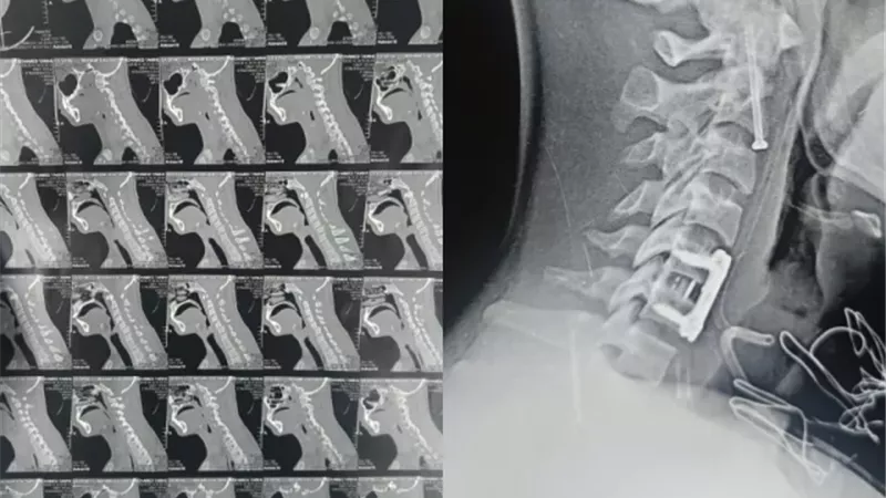 نجاح جراحة دقيقة لإنقاذ مريض من شلل رباعي بمستشفيات جامعة بنها