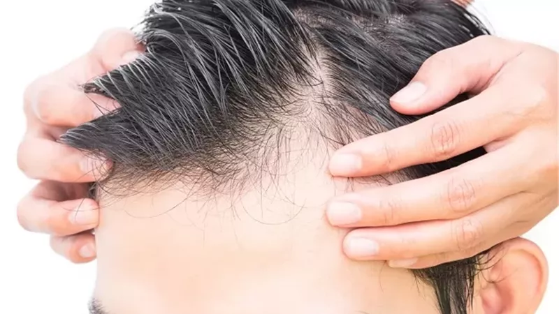 البلازما للشعر .. حل سريع وفعّال لتقليل التساقط
