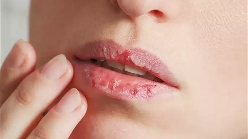 تشقق الشفاه .. الأسباب الشائعة وطرق الوقاية والعلاج