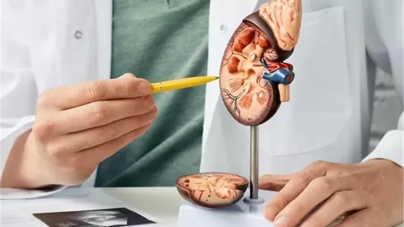 حصوات الكلى .. الأسباب والأعراض وطرق العلاج والوقاية