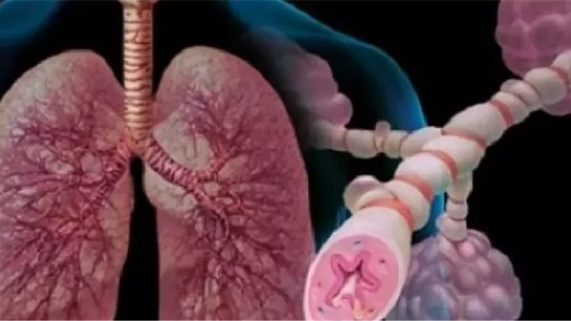 محفزات غير متوقعة لنوبات الربو قد تواجهها يوميًا دون أن تنتبه