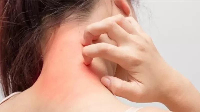 3 نصائح طبيعية تقلل حدة الأكزيما وتحمي البشرة