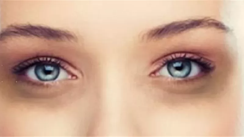 6 أسباب للهالات السوداء وكيفية التعامل معها