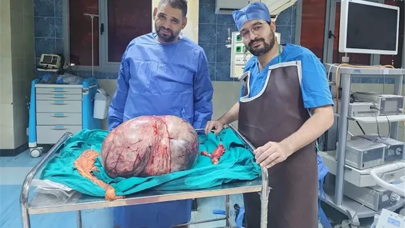 استئصال ورم مبيضي عملاق يزن 24 كيلوجرامًا داخل مستشفى الجامعي
