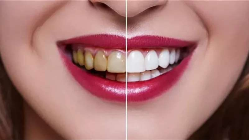 من المطبخ إلى فرشاة الأسنان .. طرق طبيعية لتعزيز بياض الأسنان