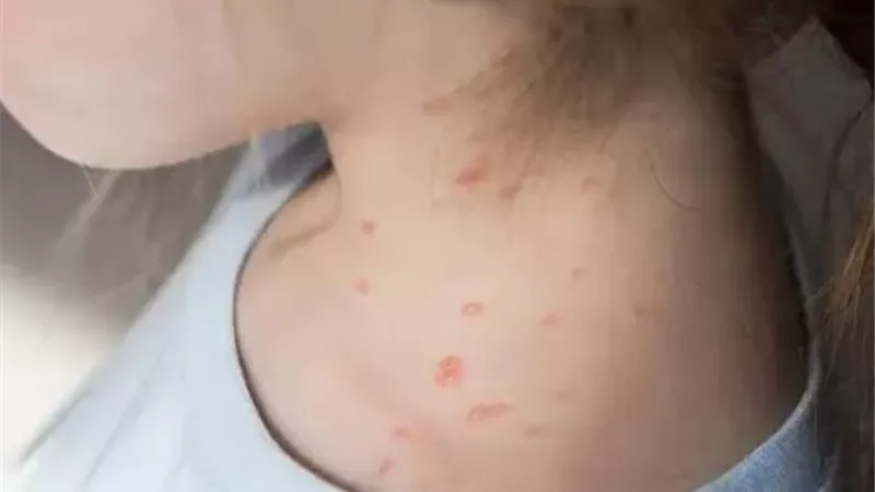 هل يمكن أن تصاب بجدري الماء مرتين؟