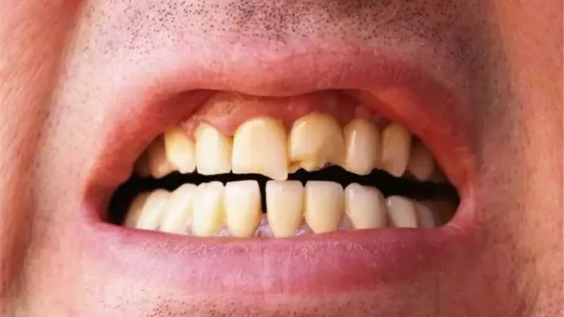 تعرف على أسباب تغير لون أسنانك