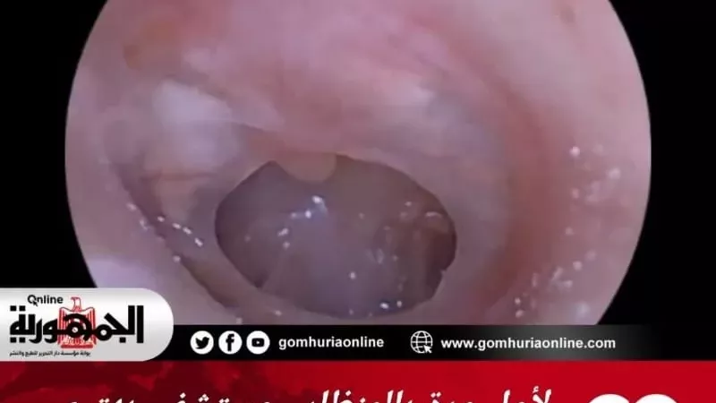 مستشفى بهتيم المركزي تنجح في إجراء عملية ترقيع ثقب بطبلة الأذن