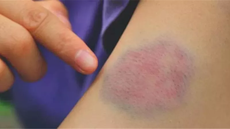 اكتشاف آلية تسبب جلطات خطيرة بعد استخدام الهيبارين