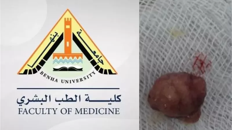 نجاح استئصال ورم بالقولون بالمنظار في جامعة بنها
