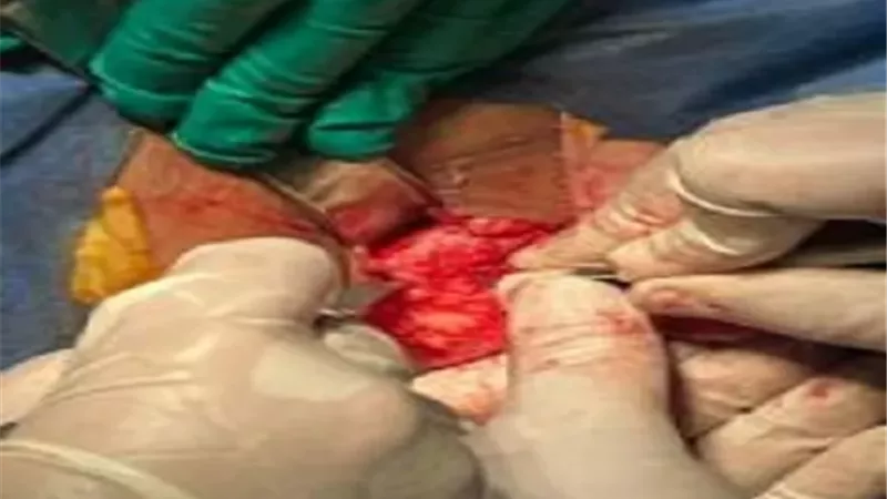 جراحة دقيقة لاستئصال وإعادة بناء جزء من فك مريضة
