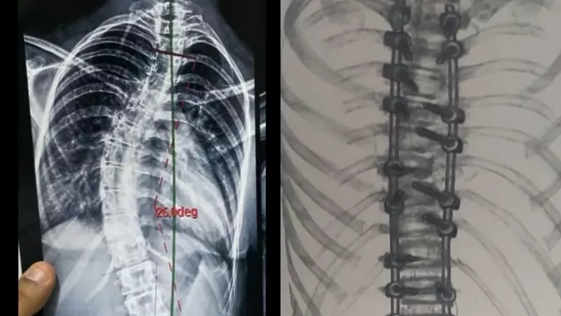 جراحة معقدة تنقذ طفلًا من اعوجاج حاد بالعمود الفقري في جامعة بنها