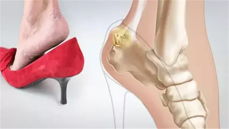 الكعب العالي أم الحذاء