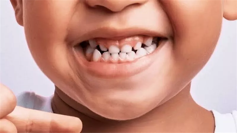 مواد كيميائية في أسنان الأطفال تثير تساؤلات جديدة حول التوحد
