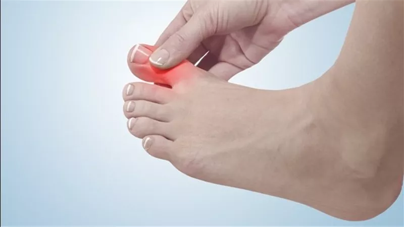 القهوة أم الشاي؟ .. دراسة تكشف علاقة المشروبات اليومية بمخاطر الإصابة بالنقرس