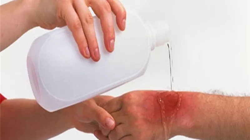 6 طرق طبيعية لعلاج الحروق في المنزل.. منها استخدام الخل