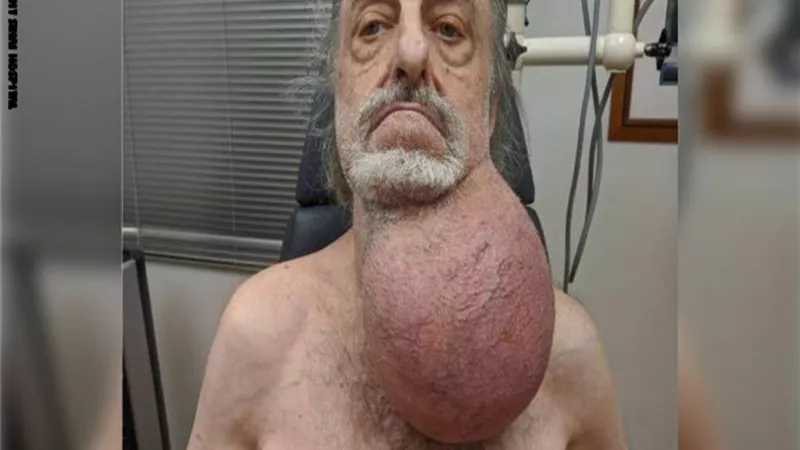 طبيب يستأصل ورم بححم كرة القدم من رقبة مسن