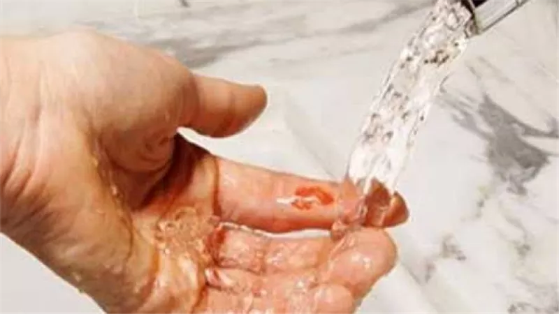 منها الخل.. طرق طبيعية لعلاج الحروق في المنزل