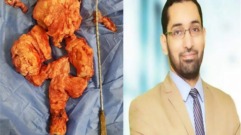 بالصور .. لأول مرة ببنها اسـتئصال ورم ضخم من رحم سيدة بالمنظار الجراحى