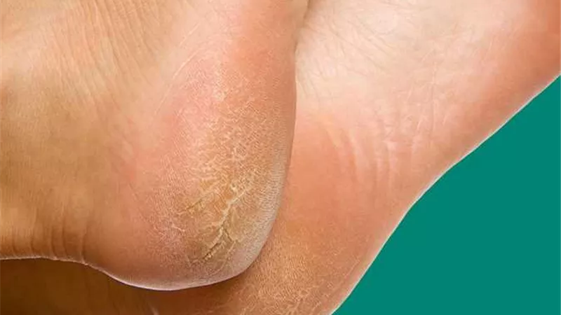 7 طرق طبيعة للتخلص من تشققات القدمين