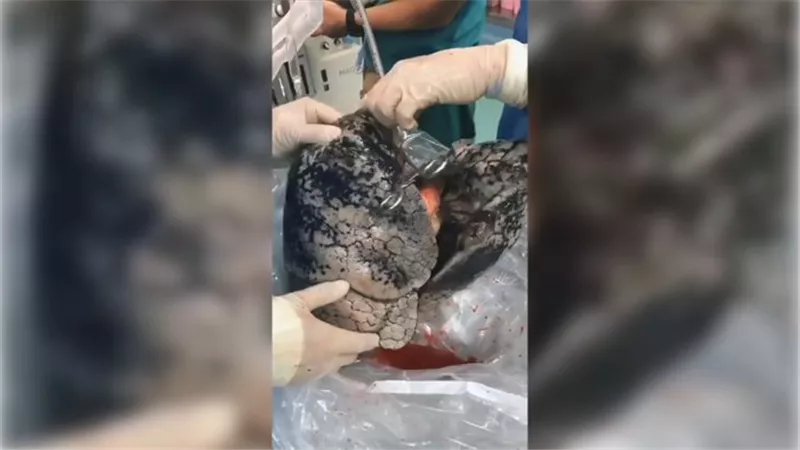مشهد مروع لرئة مدخن يثير الجدل عبر مواقع التواصل