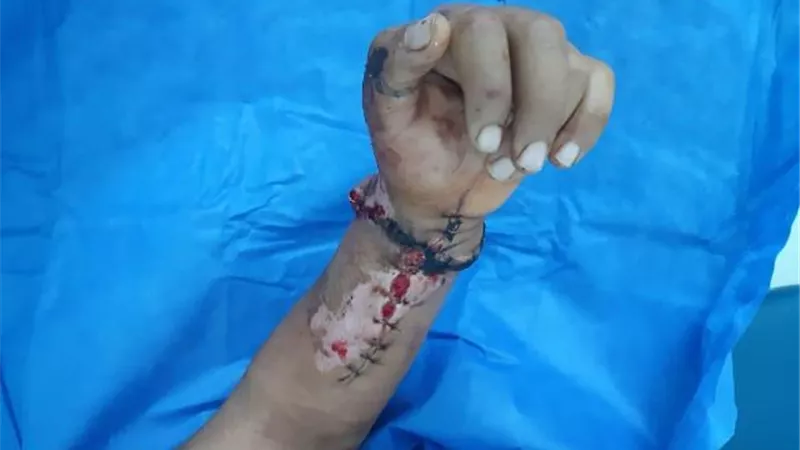 زرع يد شاب بعد بترها بالكامل فى حادث سيارة بأسيوط.. صور