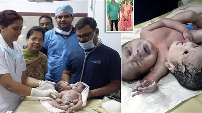 بالفيديو .. ولادة طفل برأسين و3 أذرع في حالة نادرة