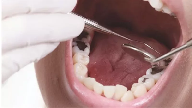 تعرف على مضاعفات ترك تسوس الأسنان دون علاج